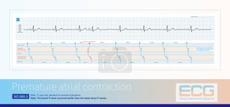 Téléchargez les photos : Le diagnostic ECG de contraction auriculaire prématurée est une onde P précoce dont la morphologie diffère de celle de l'onde P sinusale et qui est généralement incomplète à intervalles compensatoires.. - en image libre de droit
