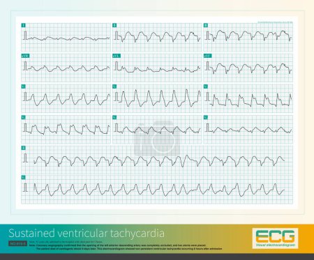 Photo for Male, 52 years old, diagnosed with acute extensive anterior wall myocardial infarction. The patient repeatedly experienced ventricular tachycardia and eventually died of cardiogenic shock. - Royalty Free Image