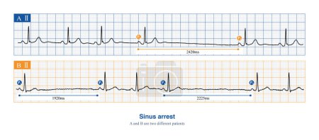 Photo for When sinus arrest occurs, the electrocardiogram will show a long P-P interval, which is not multiples of the basal sinus cycle, including physiological and pathological reasons. - Royalty Free Image