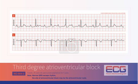 Photo for Third degree atrioventricular block in young women may be congenital, with the block located on the atrioventricular node or above bifurcation of the His bundle. - Royalty Free Image
