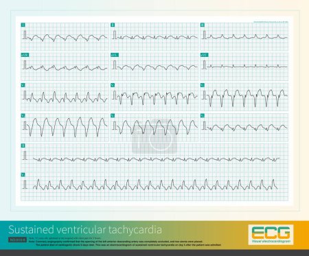 After acute myocardial infarction, there is a high incidence of ventricular tachycardia within 2 weeks. Ventricular tachycardia is a common arrhythmia in patients with myocardial infarction.