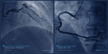 Photo for Male, 65 years old, admitted with chest pain for 2 hours. Coronary angiography indicates subtotal occlusion of the proximal to middle segment of the left anterior descending artery. - Royalty Free Image