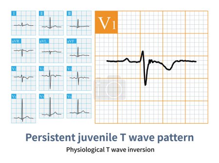 Children and young adults, especially young women, have a physiological inversion of the T wave in the right chest lead. Do not misdiagnose it as acute pulmonary embolism.