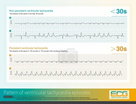 Cuando la duración de un ataque de taquicardia ventricular excede de 30 segundos o es inferior a 30 segundos acompañado de inestabilidad circulatoria, se denomina taquicardia ventricular persistente..