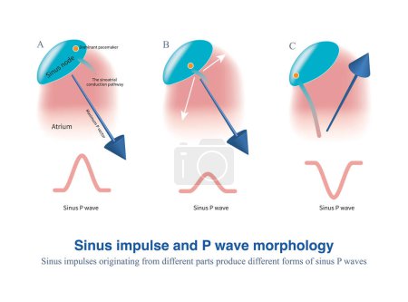 Les impulsions sinusales provenant de différentes parties du noeud sinoauriculaire produisent différents modèles d'excitation et de potentiel auriculaire, ce qui entraîne une morphologie diversifiée des ondes P sinusales..