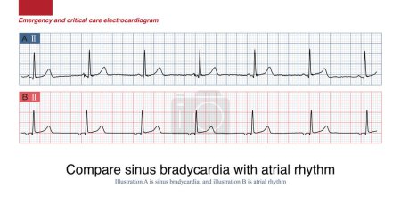 Téléchargez les photos : Lorsque la bradycardie sinusale est trouvée, l'un des diagnostics différentiels importants sur l'ECG est le rythme auriculaire, et généralement la morphologie de l'onde P est complètement différente de l'onde P sinus. - en image libre de droit