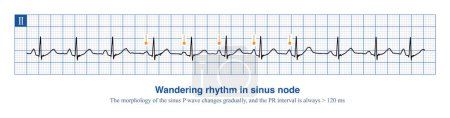 Lorsque le stimulateur cardiaque dominant du noeud sinusal change à l'intérieur du noeud sinusal, la morphologie et la fréquence des ondes sinusales P changent, ce qui entraîne un rythme errant..