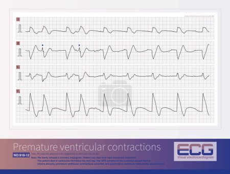 A patient with AIMI presents with a sudden widening of the QRS complex in the junctional escape rhythm, premature ventricular contractions, resulting in  polymorphic ventricular tachycardia.