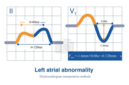 Photo for The ECG changes of left atrium abnormality include widening of P wave duration, bimodal P wave and increasing of P wave terminal potential in lead V1 lead P wave. - Royalty Free Image