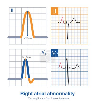 El estándar para el diagnóstico de la anomalía auricular derecha en el ECG es que la amplitud de la onda P en los cables de las extremidades I es mayor de 2,5 mm, y la amplitud de la onda P vertical en los cables torácicos es de 1,5 mm..
