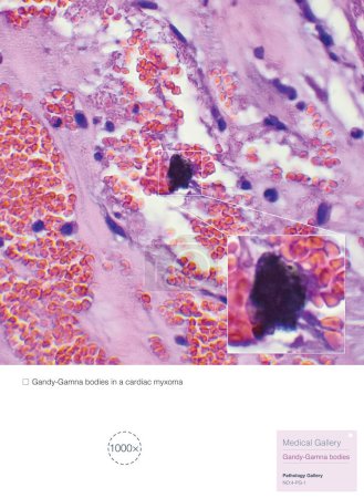 Foto de Los cuerpos de Gandy-Gamna son cambios patológicos que involucran hemosiderosina y depósitos de sal cálcica producidos por la descomposición de glóbulos rojos y la encapsulación de tejido fibroso.. - Imagen libre de derechos