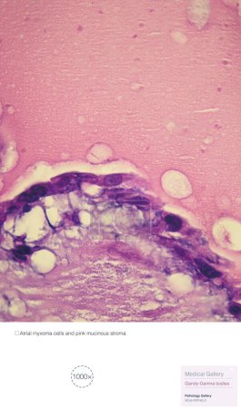 Pathologic changes in atrial myxoma, this image shows myxoma cells and pink mucinous stroma. Atrial myxoma is a benign tumor of the heart.