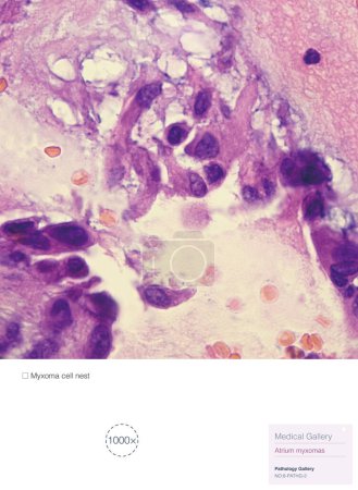 Cette photographie pathologique met en évidence le nid de cellules de myxome auriculaire. Myxome auriculaire est une tumeur bénigne du c?ur.
