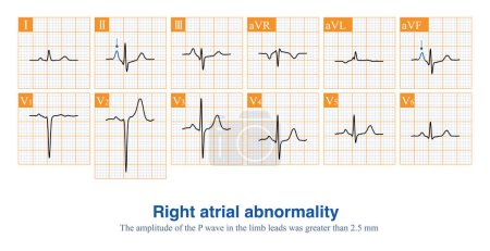 Photo for Male, 67 years old, with a clinical diagnosis of chronic obstructive pulmonary disease. ECG showed sinus rhythm and right atrial abnormality. - Royalty Free Image