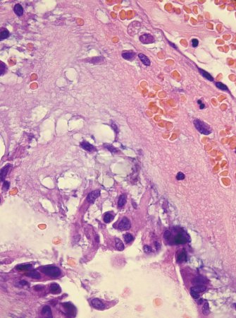 Esta fotografía patológica destaca el nido de células del atrio Myxoma. El mixoma auricular es un tumor benigno del corazón..