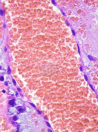 Une grande hémorragie à l'intérieur du myxome auriculaire, des globules rouges et des myxomes violets sont visibles. Myxome auriculaire est une tumeur bénigne du c?ur.Magnifier 1000x