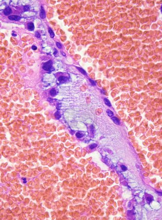 Esta fotografía patológica destaca las células del mixoma auricular en la estructura del cordón umbilical. El mixoma auricular es un tumor benigno del corazón.Ampliar 1000x