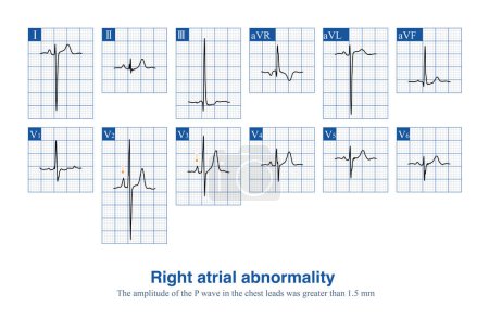Photo for Male, 10 years old, was clinically diagnosed with tetralogy of Fallot. ECG shows an elevated P wave amplitude in thoracic leads, suggesting right atrial abnormality. - Royalty Free Image