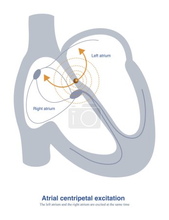 When ectopic focal areas in the atria are located in the atrial septum, the left atrium and right atrium can be excited at the same time, producing a very narrow P wave.