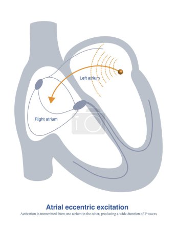 When intraatrial excitation is transmitted from one atrium to the other, a wider duration of P waves are generated, such as sinus rhythm, lateral  left atrial focal, etc.