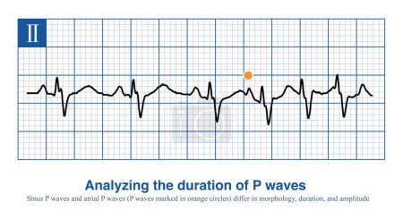 When intraatrial excitation is transmitted from one atrium to the other, a wider duration of P waves are generated, such as sinus rhythm, lateral  left atrial focal, etc.
