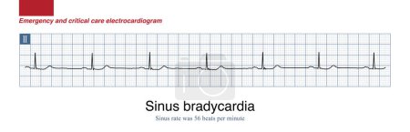 Photo for Male, 71 years old, was clinically diagnosed with upper gastrointestinal bleeding. During sleep at night, ECG monitoring showed sinus bradycardia, blood pressure 115 and 70mmHg. - Royalty Free Image
