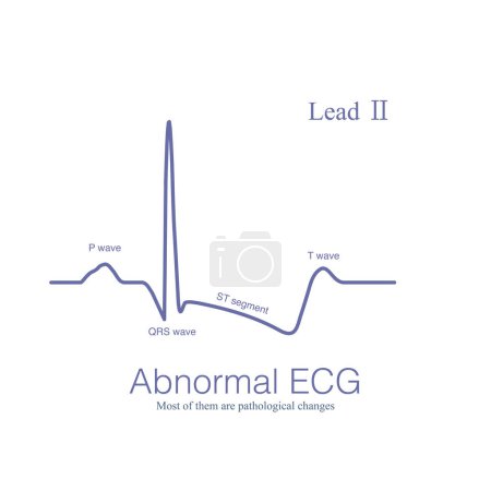 Photo for Abnormal ECG refers to changes in depolarization waves and or repolarization waves, most of which are pathologic and few are physiological. - Royalty Free Image