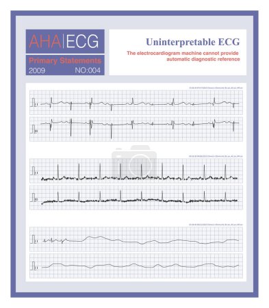 When the ECG is too complex, the recording quality is poor, or it is impossible to interpret what is causing the loss of the ECG, the ECG machine will not be able to provide a diagnostic reference.