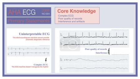 Lorsque l'ECG est trop complexe, que la qualité de l'enregistrement est mauvaise ou qu'il est impossible d'interpréter ce qui cause la perte de l'ECG, la machine ECG ne sera pas en mesure de fournir une référence diagnostique..