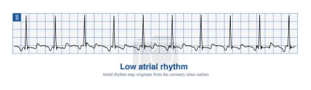 When the rhythm of the atria originates in the lower part of the atria, the whole atria are excited from inferior to superior, producing negative P waves in the inferior leads.