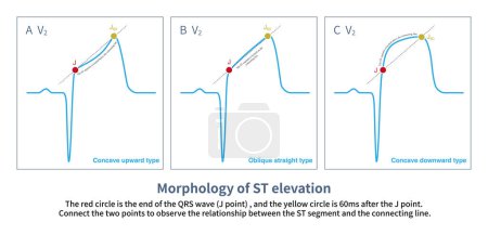 According to the offset amplitude of the ST segment at J point and J60 point, ST segment elevation can be divided into three basic types: concave upward, oblique straight and concave downward type.