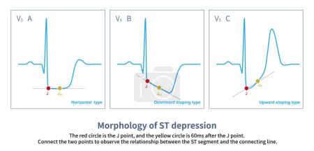 Cuando el segmento ST está deprimido, la amplitud de la depresión en el punto J y el punto J60 se puede dividir en tres tipos: horizontal (A), inclinación descendente (B) y inclinación ascendente (C).