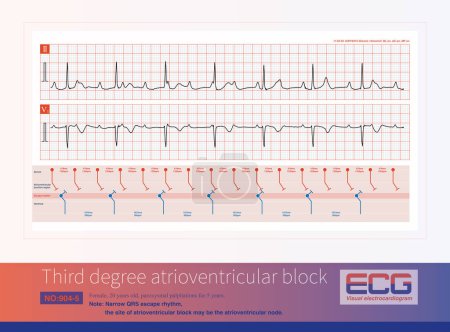 Third degree atrioventricular block in young women may be congenital, with the block located on the atrioventricular node or above bifurcation of the His bundle.