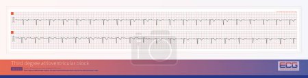 Third degree atrioventricular block in young women may be congenital, with the block located on the atrioventricular node or above bifurcation of the His bundle.