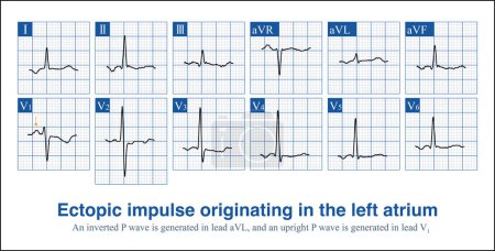 When ectopic impulses from the anterior wall of the right atrium produce a completely negative P wave in lead V1, the posterior wall ectopic impulse produces a positive and negative biphasic P wave.