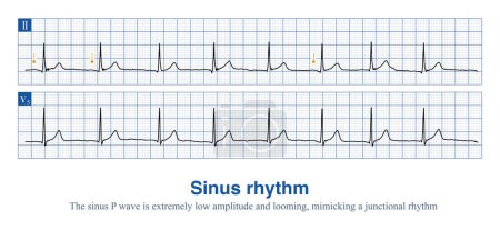 Sometimes, the P wave amplitude of sinus rhythm is so low that it is close to an isopotential and can easily be mistaken for a borderline rhythm.