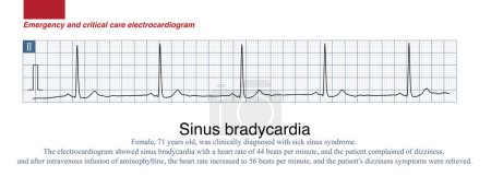 Photo for Sinus heart rate less than 60 beats per minute in adults is called sinus bradycardia. A sinus heart rate of 40 to 50 beats per minute is moderate sinus bradycardia, and patients may have symptoms such as palpitations and dizziness. - Royalty Free Image
