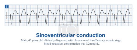 Téléchargez les photos : Lorsque la concentration de potassium dans le sang augmente dans une certaine mesure, paralysie musculaire auriculaire accompagnée d'un trouble de conduction ventriculaire, ECG sans onde P sinusale accompagnée de larges ondes QRS. - en image libre de droit