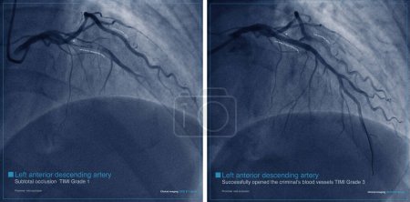 Photo for Male, 65 years old, was clinically diagnosed with acute anterior myocardial infarction. The patient was treated with a coronary stent, but no reperfusion T wave occurred on day 2. - Royalty Free Image