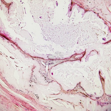 Esta es una foto patológica de un nódulo de gota humana, que muestra la formación de sustancias eosinofílicas amorfas rosadas por cristales de urato..