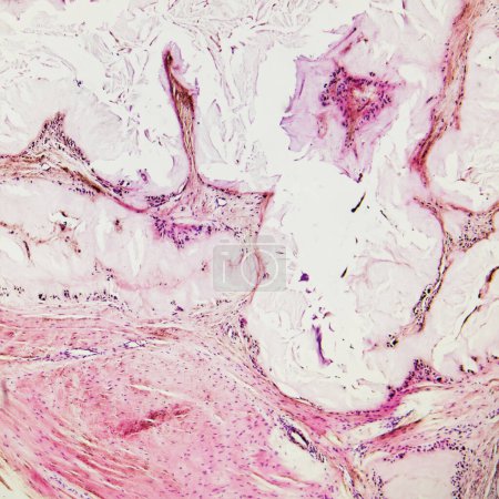 Dies ist ein pathologisches Foto eines menschlichen Gichtknotens, das die Bildung amorpher eosinophiler rosafarbener Substanzen durch Uratkristalle und chronisches Granulom zeigt..