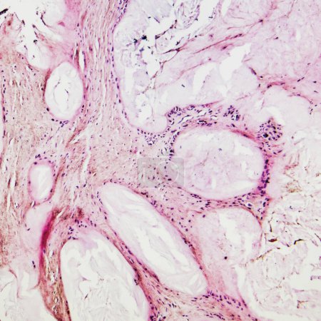 Dies ist ein pathologisches Foto eines menschlichen Gichtknotens, das die Bildung von rosa amorphen eosinophilen Substanzen durch Uratkristalle zeigt..