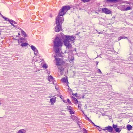 Foto de Esta es una foto patológica de un nódulo de gota humana, que muestra la formación de sustancias eosinofílicas amorfas rosadas por cristales de urato.. - Imagen libre de derechos