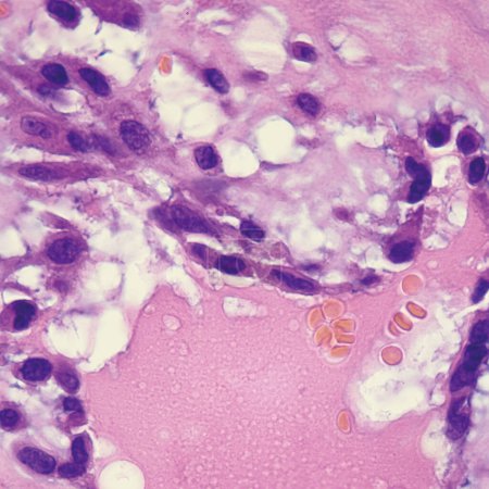 Cette photo montre la matrice mucineuse rose et l'arrangement semblable à un nid de cellules tumorales mucineuses dans le myxome auriculaire..