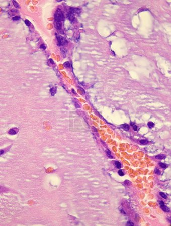 Dieses Foto zeigt die rosa Schleimmatrix und nestartige Anordnung von schleimigen Tumorzellen im Vorhofmyxom. Vergrößern Sie 1000x.