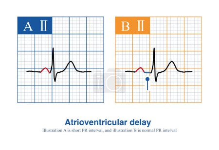 Aufgrund der langsamen Leitung des AV-Knotens sollte das PR-Intervall des Erwachsenen-EKGs größer als 120ms sein. Dieses physiologische Phänomen wird als atrioventrikuläre Verzögerung bezeichnet.