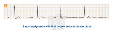 Photo for During nocturnal sleep, vagus tone is elevated, and ECG may show both sinus bradycardia and first-degree atrioventricular block. - Royalty Free Image