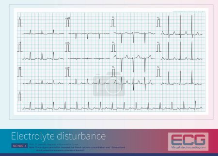 The presence of ST-segment prolongation and T wave symmetry and high tip on ECG suggests hypocalcemia and hyperkalemia.