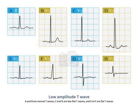 Das Vorhandensein von ST-Segmentverlängerung und T-Wellensymmetrie und hoher Spitze beim EKG deutet auf Hypokalzämie und Hyperkaliämie hin.