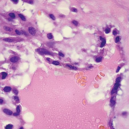 Esta foto muestra el estroma mucinoso rosado de un mixoma auricular y las células del mixoma dispuestas en un patrón anidado y similar a un cordón umbilical..
